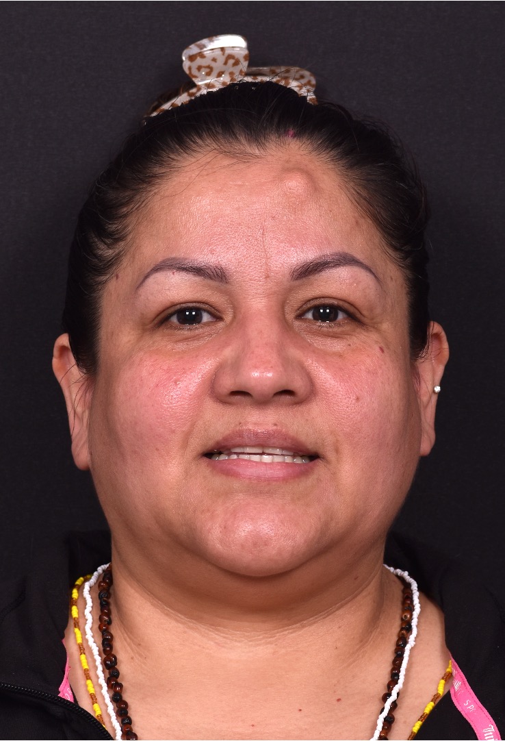 Atlanta osteoma forehead knot bump bone lipoma scarless female plastic surgeon collagen