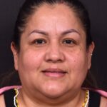 Atlanta osteoma forehead knot bump bone lipoma scarless female plastic surgeon collagen