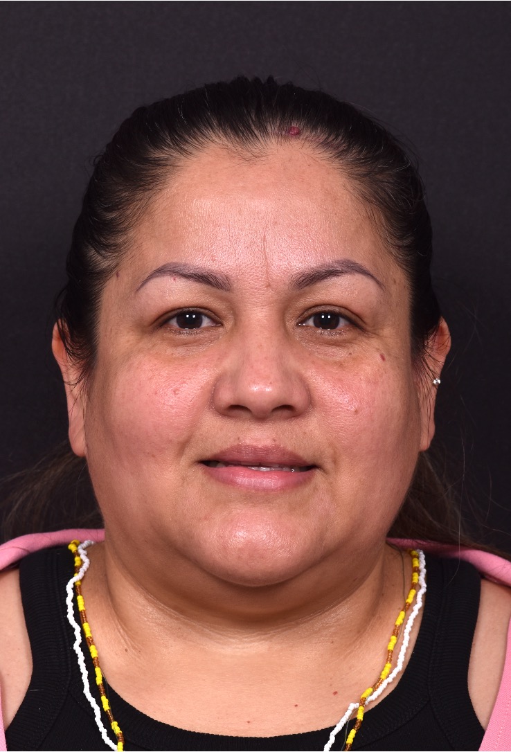 Atlanta osteoma forehead knot bump bone lipoma scarless female plastic surgeon collagen