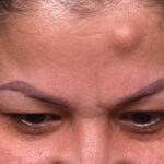 Atlanta osteoma forehead knot bump bone lipoma scarless female plastic surgeon collagen