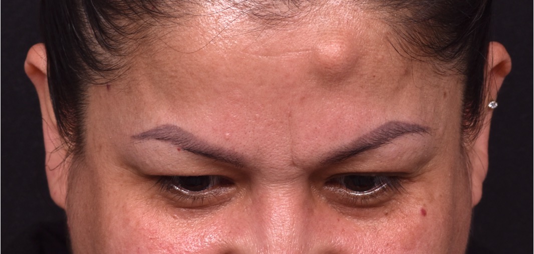 Atlanta osteoma forehead knot bump bone lipoma scarless female plastic surgeon collagen