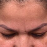 Atlanta osteoma forehead knot bump bone lipoma scarless female plastic surgeon collagen