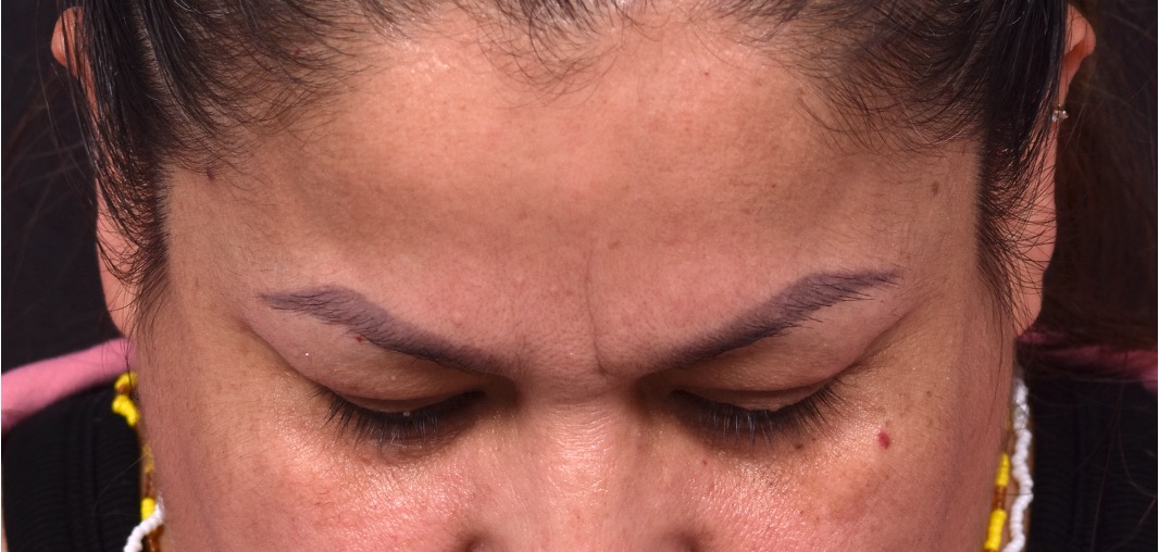 Atlanta osteoma forehead knot bump bone lipoma scarless female plastic surgeon collagen