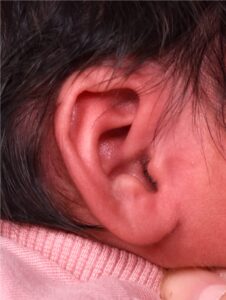 Earwell Atlanta newborn ear correction before after results painless nonsurgical otoplasty