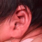 Earwell Atlanta newborn ear correction before after results painless nonsurgical otoplasty