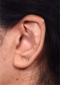 Otoplasty ear surgery reshape cartilage earlobe collagen Atlanta