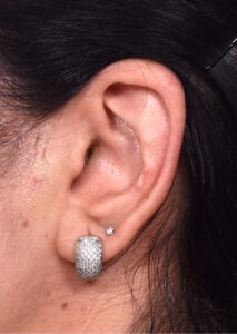 Otoplasty ear surgery reshape cartilage earlobe collagen Atlanta