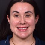 Lip lift bullhorn corner near me best expert facial plastic surgeon collagen Atlanta