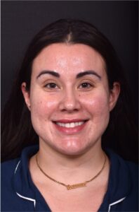 Lip lift bullhorn corner near me best expert facial plastic surgeon collagen Atlanta