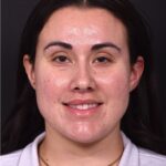 Lip lift bullhorn corner near me best expert facial plastic surgeon collagen Atlanta