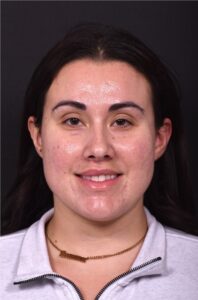 Lip lift bullhorn corner near me best expert facial plastic surgeon collagen Atlanta