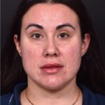 Lip lift bullhorn corner near me best expert facial plastic surgeon collagen Atlanta