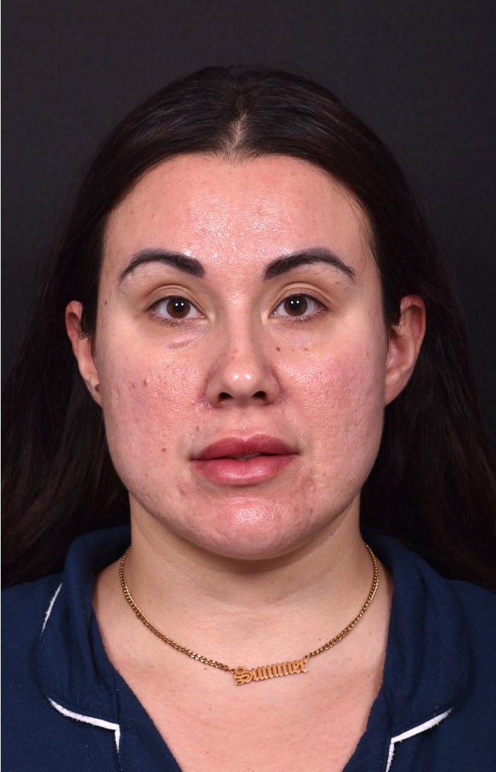 Lip lift bullhorn corner near me best expert facial plastic surgeon collagen Atlanta