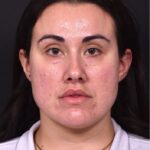 Lip lift bullhorn corner near me best expert facial plastic surgeon collagen Atlanta