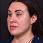 Lip lift bullhorn corner near me best expert facial plastic surgeon collagen Atlanta