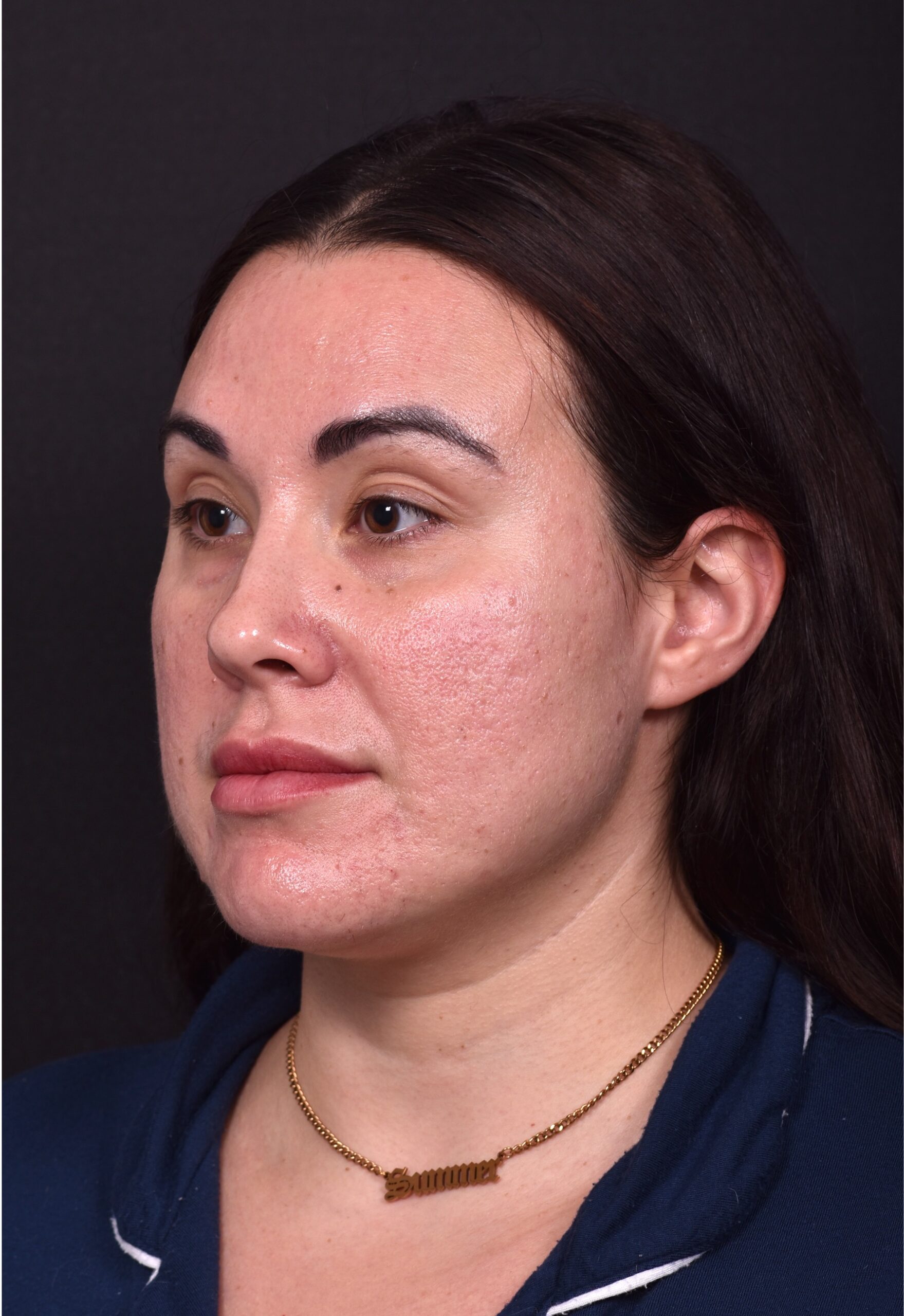 Lip lift bullhorn corner near me best expert facial plastic surgeon collagen Atlanta