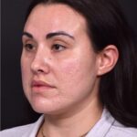 Lip lift bullhorn corner near me best expert facial plastic surgeon collagen Atlanta