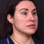 Lip lift bullhorn corner near me best expert facial plastic surgeon collagen Atlanta