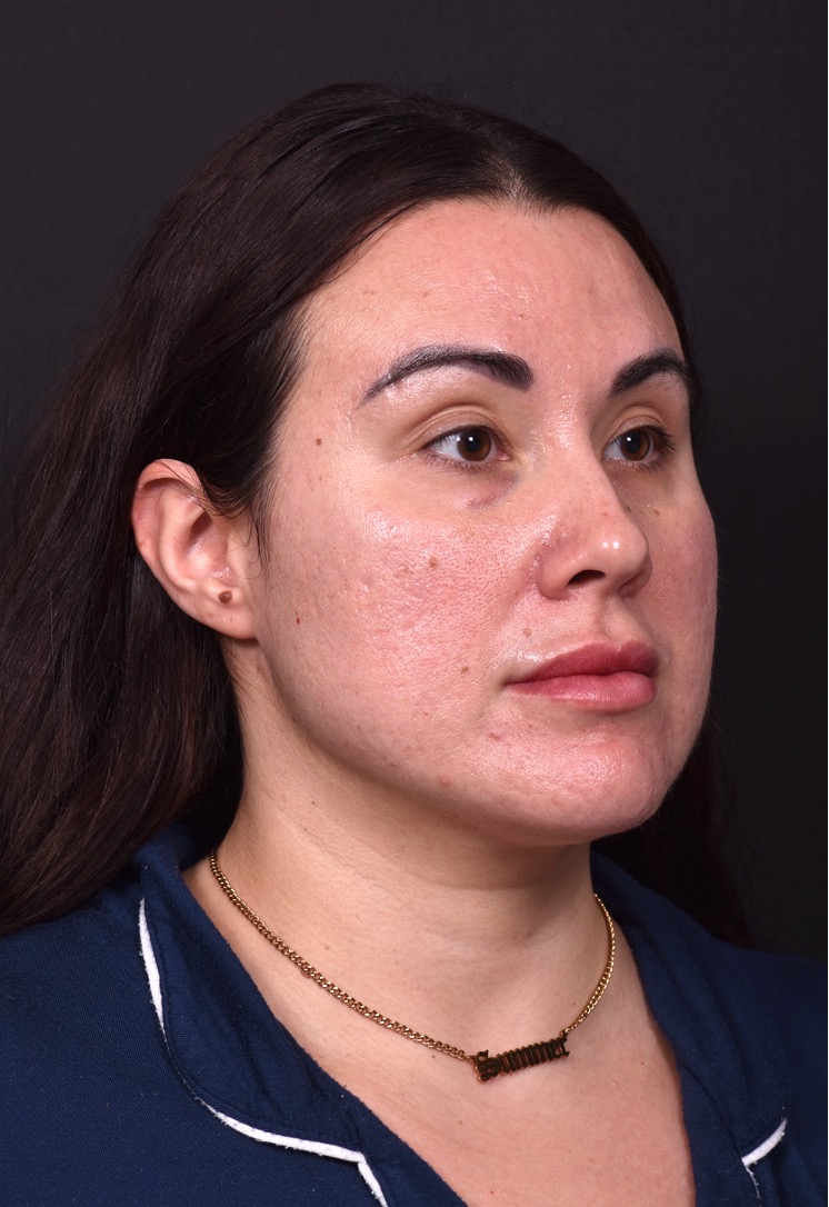 Lip lift bullhorn corner near me best expert facial plastic surgeon collagen Atlanta