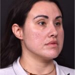 Lip lift bullhorn corner near me best expert facial plastic surgeon collagen Atlanta