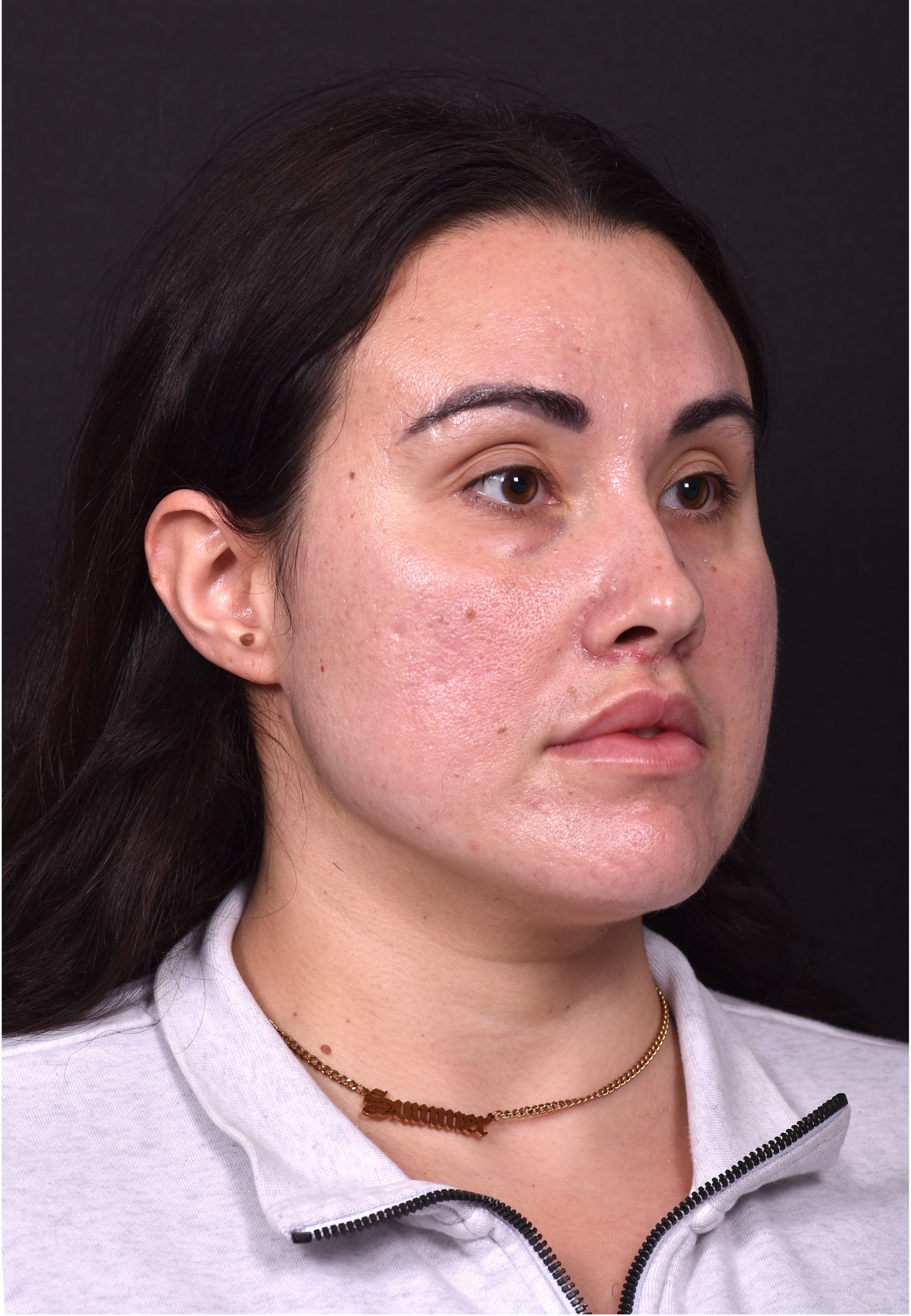 Lip lift bullhorn corner near me best expert facial plastic surgeon collagen Atlanta