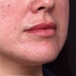Lip lift bullhorn corner near me best expert facial plastic surgeon collagen Atlanta