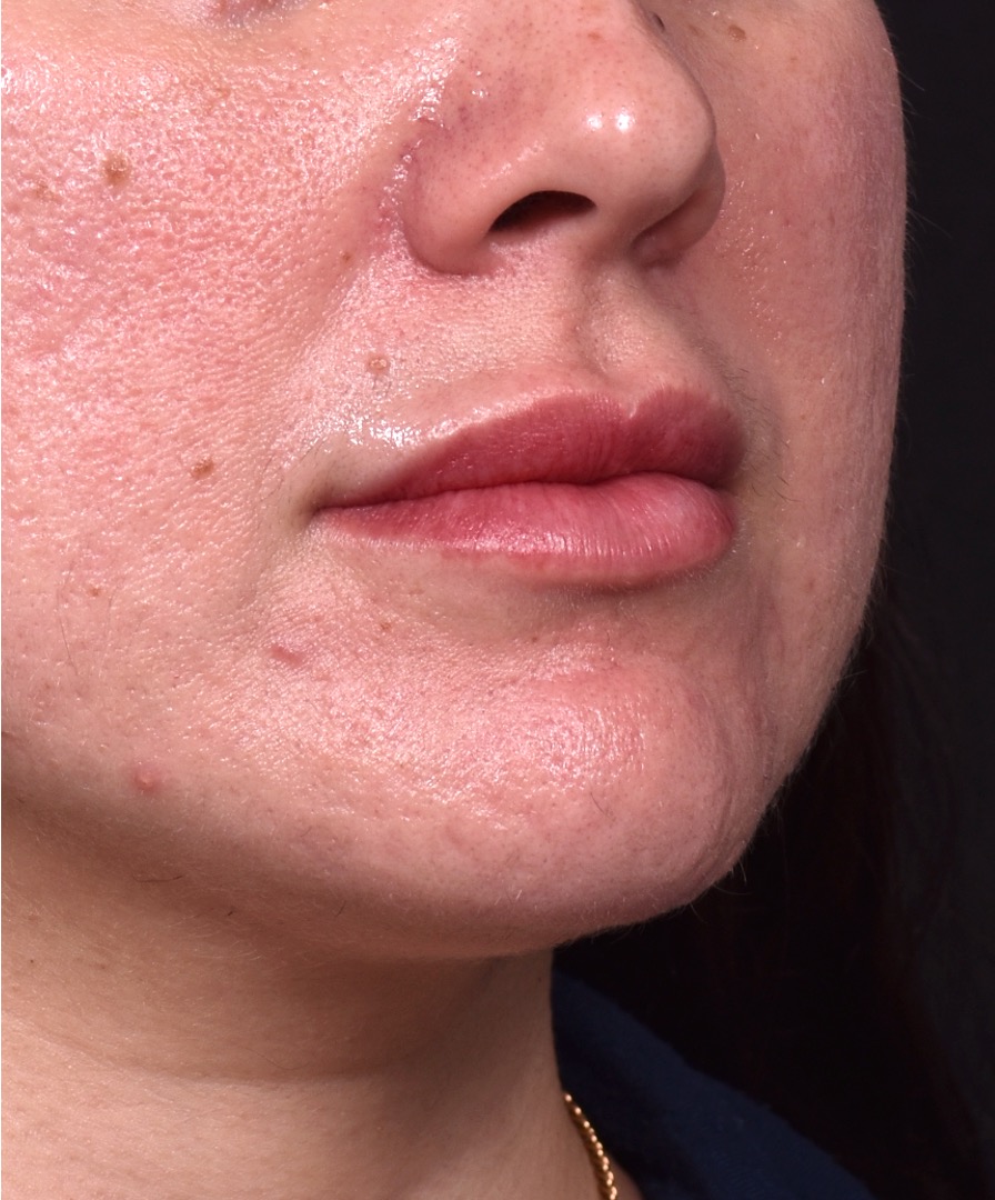 Lip lift bullhorn corner near me best expert facial plastic surgeon collagen Atlanta