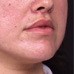 Lip lift bullhorn corner near me best expert facial plastic surgeon collagen Atlanta