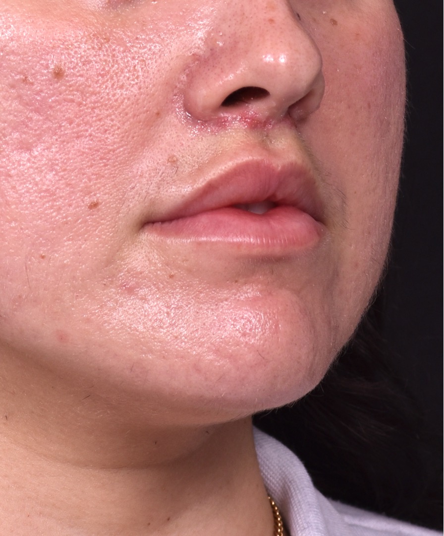 Lip lift bullhorn corner near me best expert facial plastic surgeon collagen Atlanta