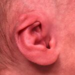 Earwell newborn ear correction nonsurgical baby otoplasty results before after best near me
