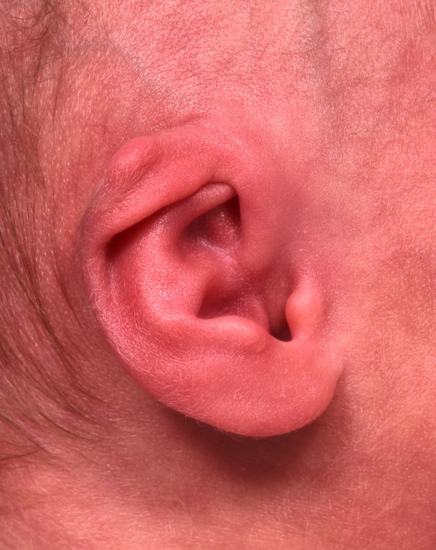 Earwell newborn ear correction nonsurgical baby otoplasty results before after best near me