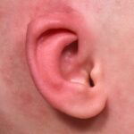 Earwell newborn ear correction nonsurgical baby otoplasty results before after best near me