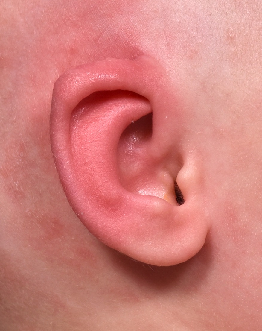 Earwell newborn ear correction nonsurgical baby otoplasty results before after best near me