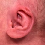 Earwell newborn ear correction nonsurgical baby otoplasty results before after best near me