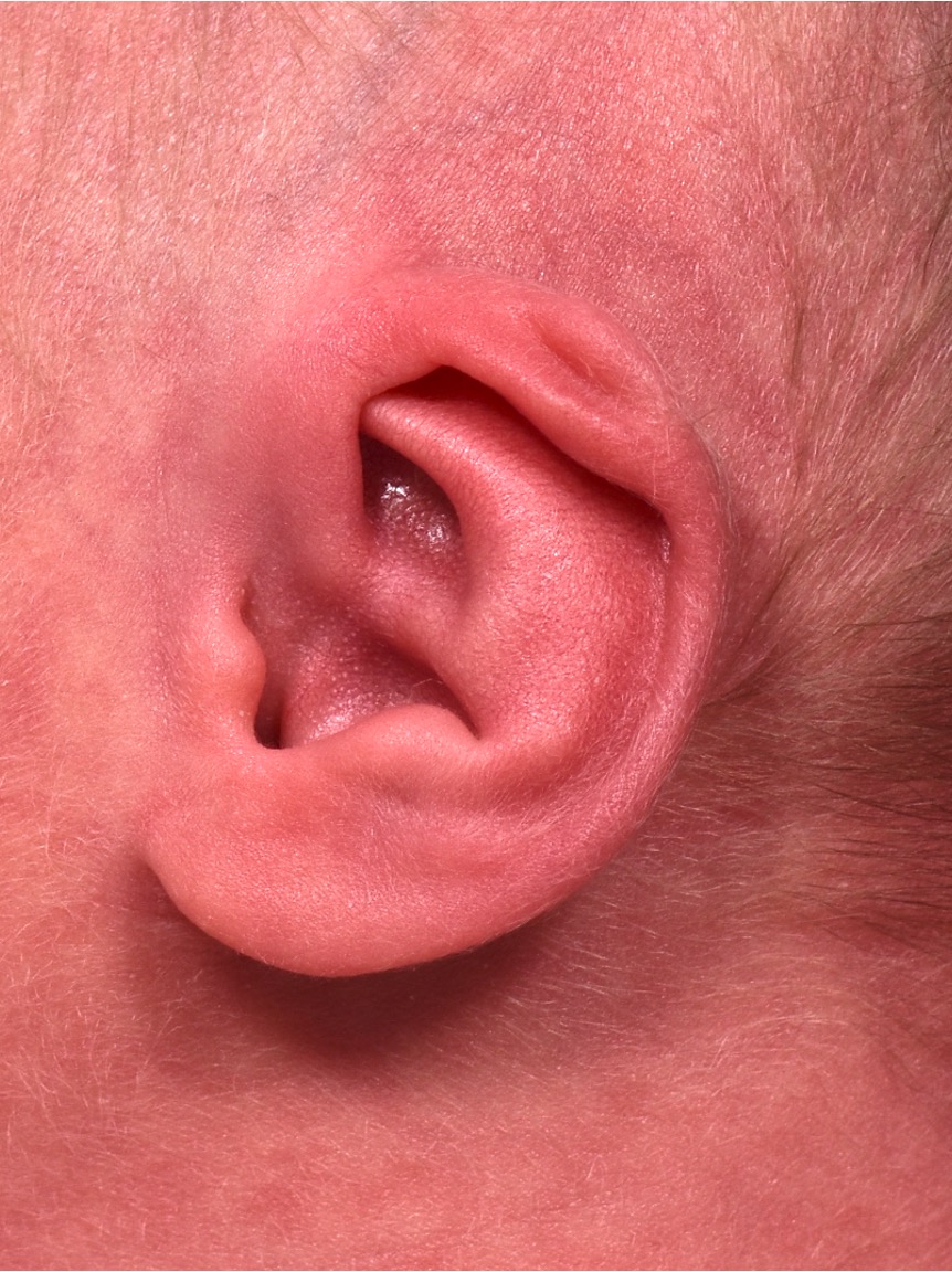Earwell newborn ear correction nonsurgical baby otoplasty results before after best near me