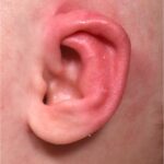 Earwell newborn ear correction nonsurgical baby otoplasty results before after best near me