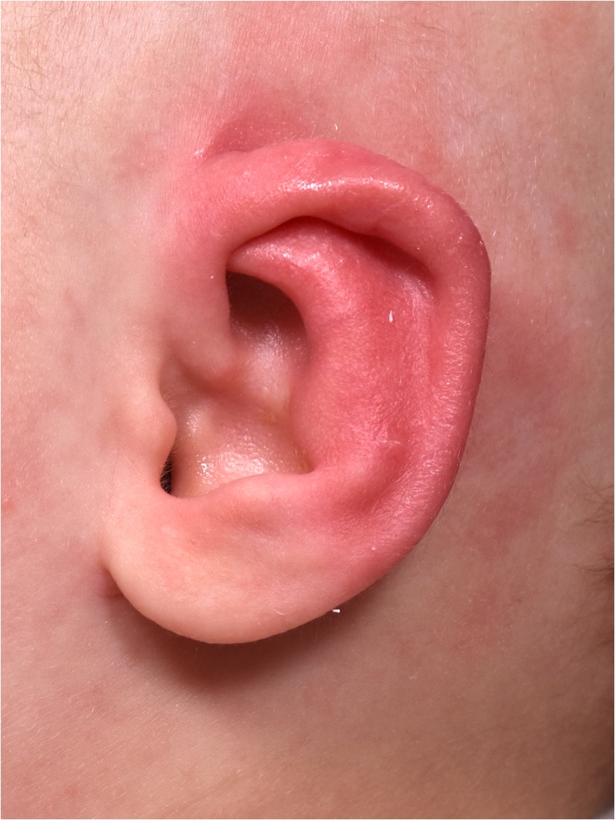 Earwell newborn ear correction nonsurgical baby otoplasty results before after best near me