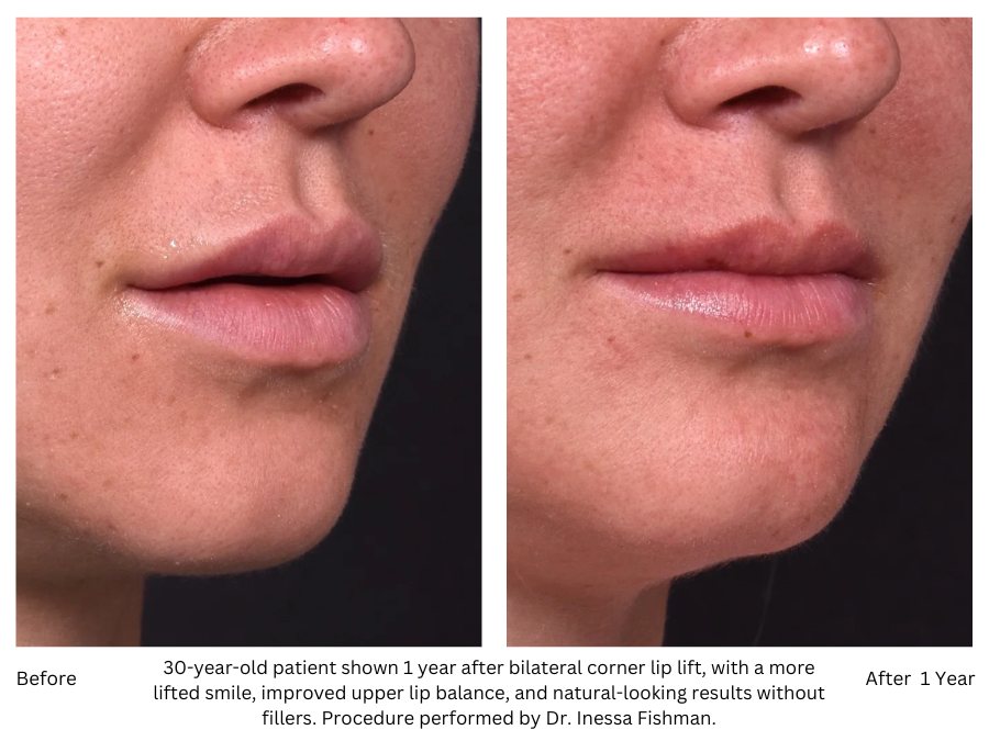 30-year-old patient shown 1 year after bilateral corner lip lift, with a more lifted smile, improved upper lip balance, and natural-looking results without fillers. Procedure performed by Dr. Inessa Fishman.