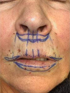 Atlanta lip lift near me bullhorn corner collagen filler flip best expert plastic surgeon female facial balancing