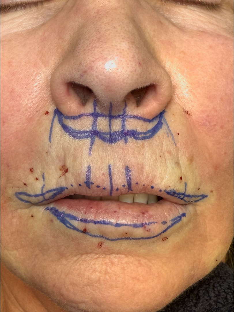 Atlanta lip lift near me bullhorn corner collagen filler flip best expert plastic surgeon female facial balancing