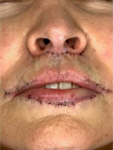 Atlanta lip lift near me bullhorn corner collagen filler flip best expert plastic surgeon female facial balancing