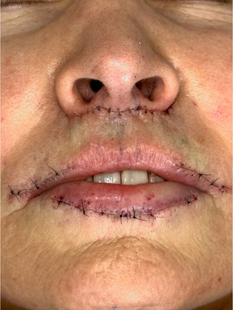 Atlanta lip lift near me bullhorn corner collagen filler flip best expert plastic surgeon female facial balancing