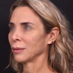 Lip lift surgery best expert near me Atlanta silicone collagen filler scarless