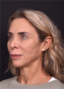 Lip lift surgery best expert near me Atlanta silicone collagen filler scarless