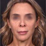 Lip lift surgery best expert near me Atlanta silicone collagen filler scarless