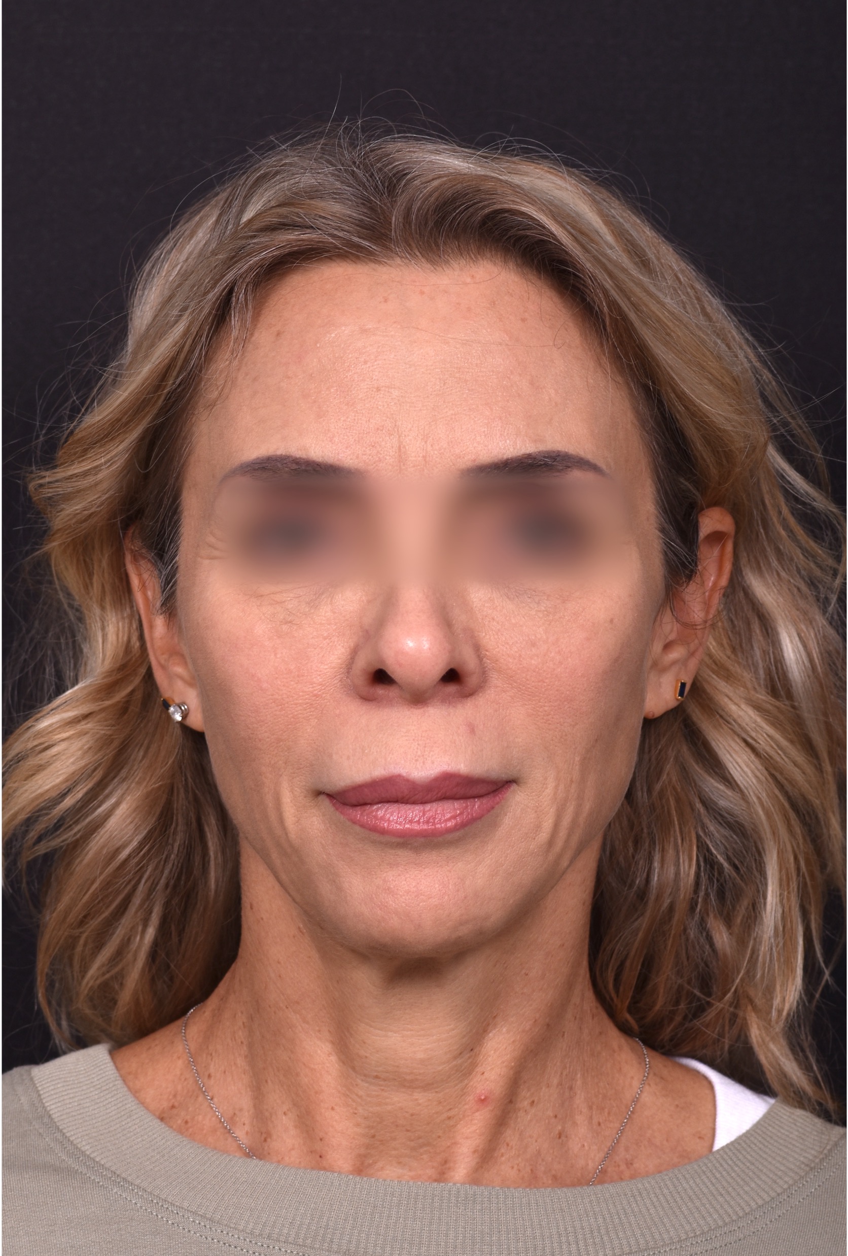 Lip lift surgery best expert near me Atlanta silicone collagen filler scarless