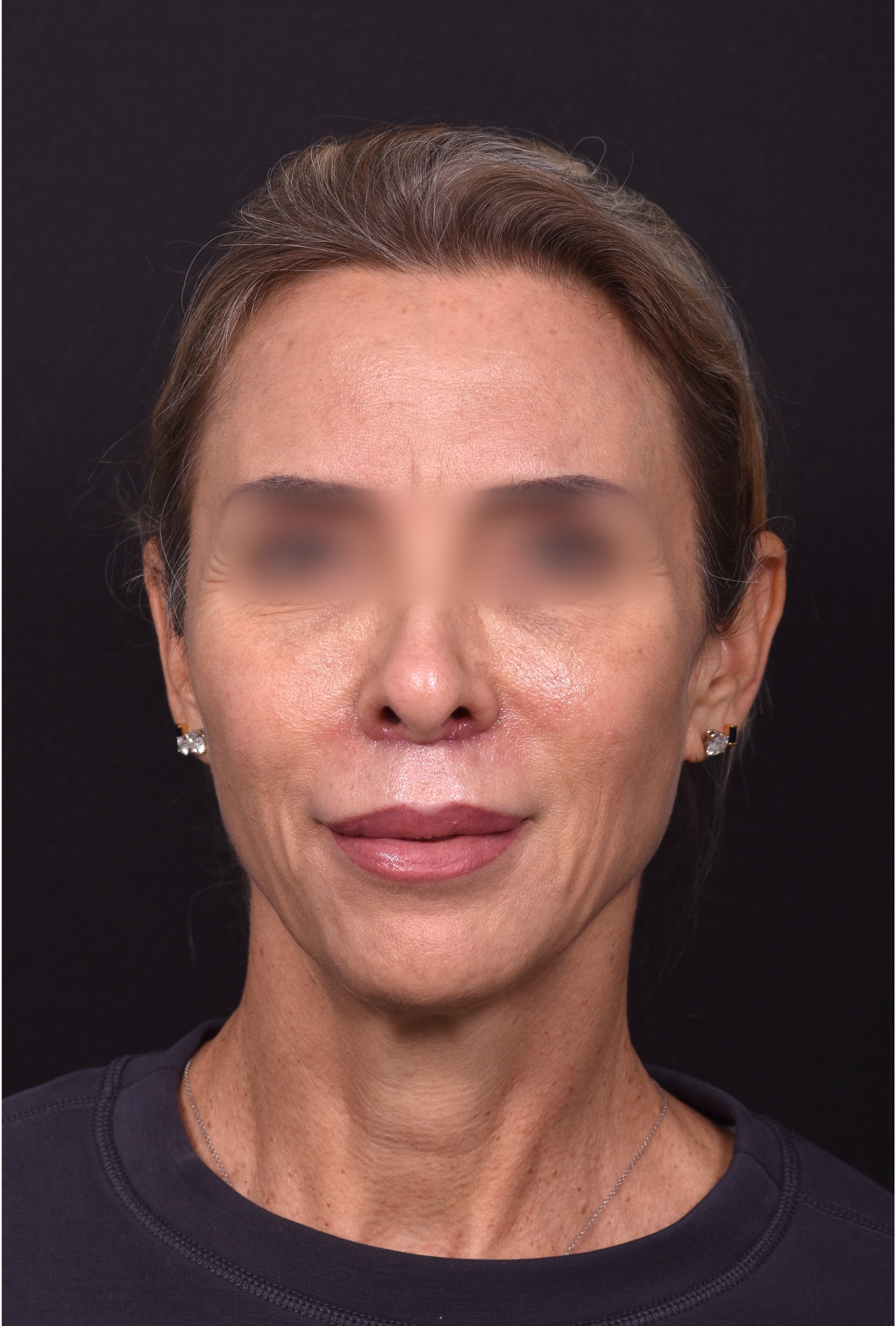 Lip lift surgery best expert near me Atlanta silicone collagen filler scarless