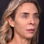 Lip lift surgery best expert near me Atlanta silicone collagen filler scarless