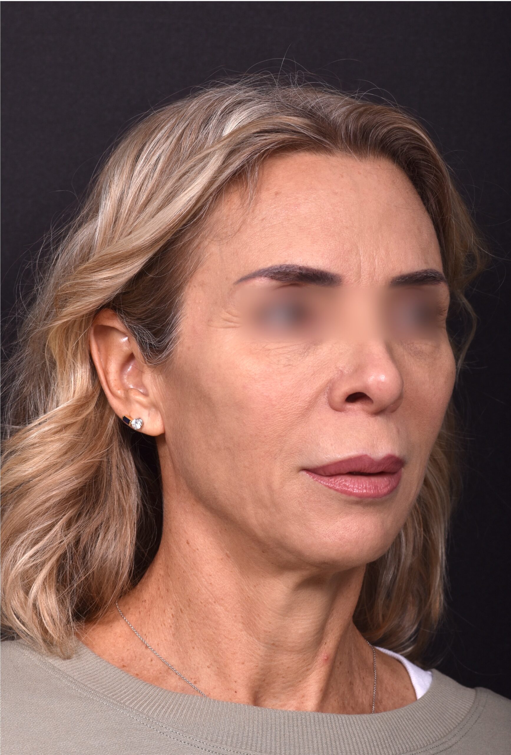 Lip lift surgery best expert near me Atlanta silicone collagen filler scarless