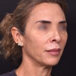 Lip lift surgery best expert near me Atlanta silicone collagen filler scarless